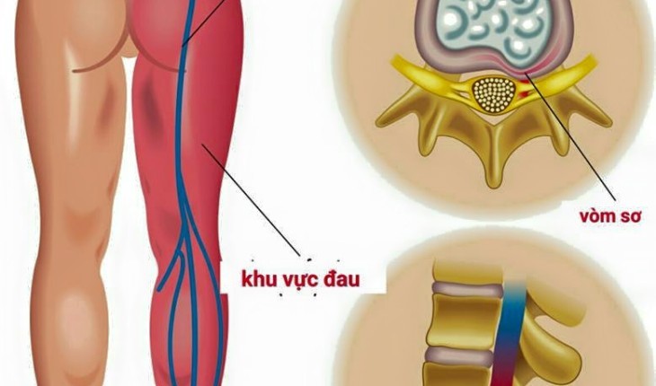 Điều trị đau thần kinh tọa