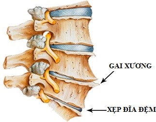 Thoái hóa đốt sống cổ